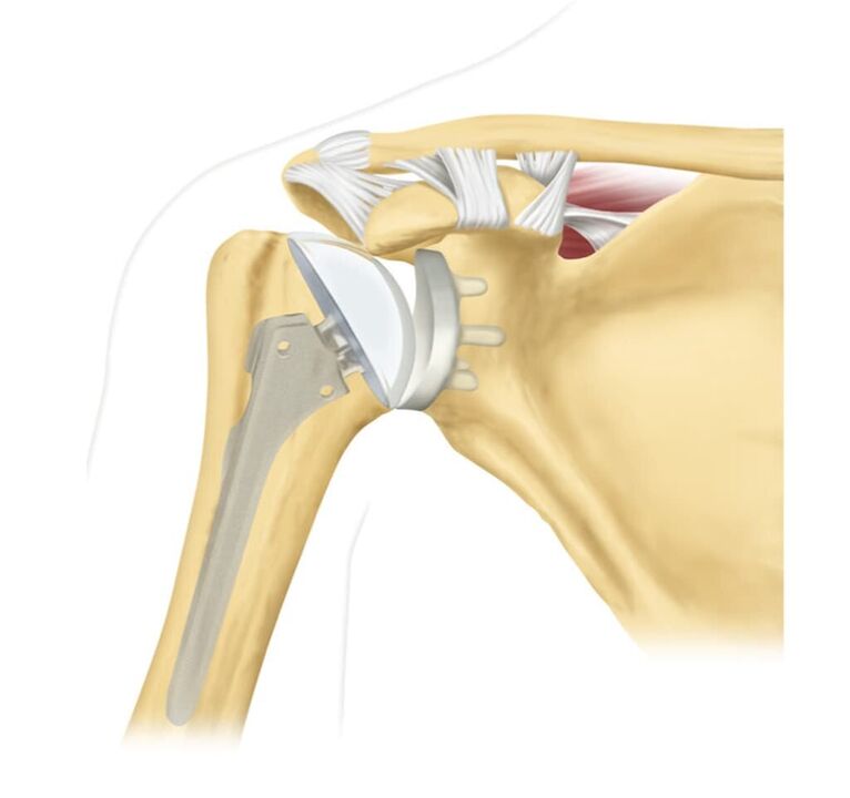 Zamenjava poškodovanega ramenskega sklepa z endoprotezo