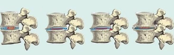 poškodbe hrbtenice v primeru torakalne osteohondroze