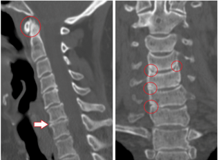 CT prikazuje poškodovana vretenca in diske heterogene višine zaradi torakalne osteohondroze