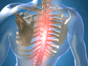 Ponavljajoča ali vztrajna boleča bolečina pri osteohondrozi prsnega koša