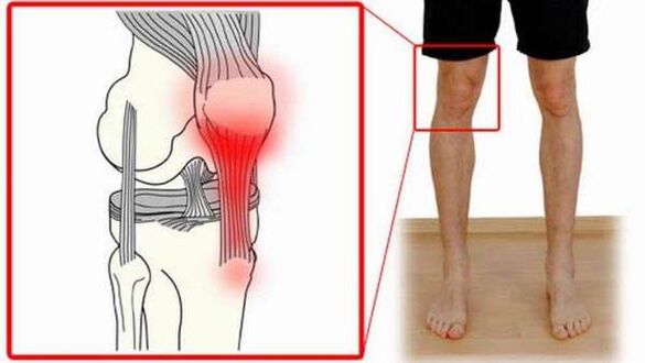 poškodbe sklepov pri artrozi ramena