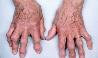 kako razlikovati artritis prstov od artroze