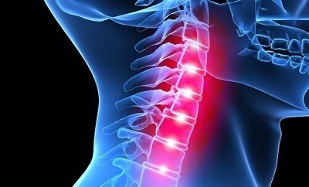 manifestacije osteohondroze vratne hrbtenice