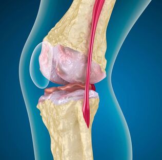 Artroza kolena