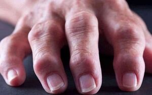 revmatoidni artritis kot vzrok za bolečine v sklepih